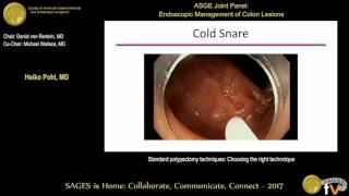 Do polyps stop you getting pregnant amp its management  Dr Rashmi Yogish [upl. by Ed887]