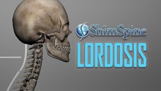 Lordosis [upl. by Ahsielat]