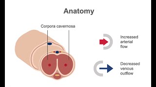 Diagnosing priapism [upl. by Clarie]