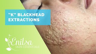 Blackheads Whiteheads Extractions on quotKquot Part 1 [upl. by Ransell77]