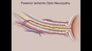 Ischemic Optic Neuropathies [upl. by Zampardi292]